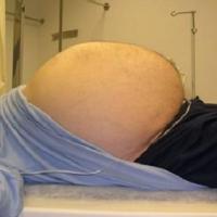 
	Liposarcoma - retroperitoneal 