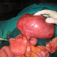 
	Liposarcoma - excision&nbsp;