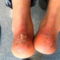 Covid vasculopathy&nbsp;
Copied with kind…