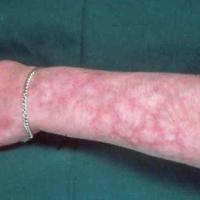 
	Livedo reticularis secondary to the APS&nbsp;