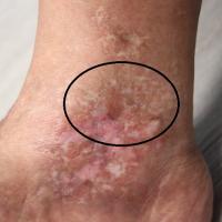 
	Livedoid vasculopathy

	Areas of white stellate…