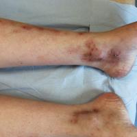 
	Livedoid vasculopathy

	&nbsp;