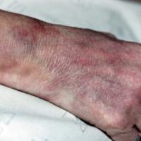 
	Livedo reticularis secondary to polyarteritis…
