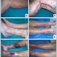 
	Cryoglobulinaemia

	Physical signs include…
