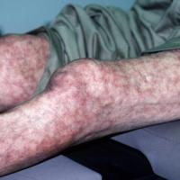 
	Livedo reticularis