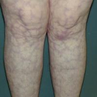 
	Livedo reticularis