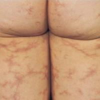 
	Sneddon's syndrome

	Livedo racemosa in a…
