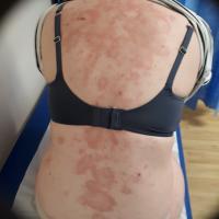 Drug-induced SCLE - PPI
Copied with kind…
