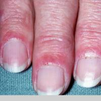 
	SLE - nailfold changes