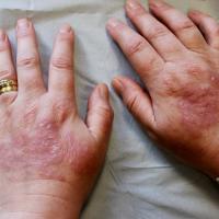 
	DLE and rheumatoid arthritis 