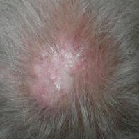 
	DLE affecting the scalp