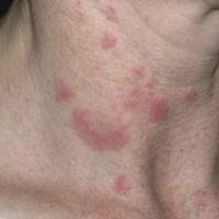 
	Lupus erythematosus tumidus