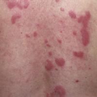 
	Lupus erythematosus tumidus