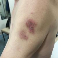 Lupus erythematous tumidus
Tumid plaques and…