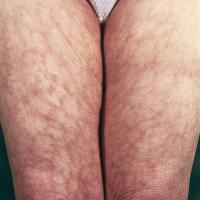 
	Livedo reticularis associated with SLE and…