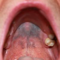 
	Hydroxychloroquine causing oral…
