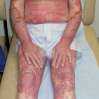 
	SCLE - severe