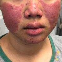 Systemic lupus erythematosus
Copied with kind…