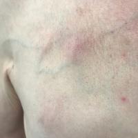 Same patient as previous image
These lesions…