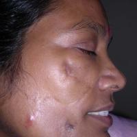
	Lupus profundus&nbsp;
