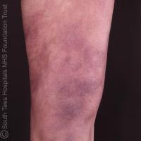 Acrodermatitis chronica atrophicansCopied with…