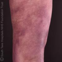 Acrodermatitis chronica atrophicansCopied with…