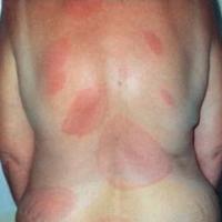 
	Erythema migrans - disseminated