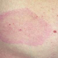 
	Erythema migrans