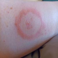 Erythema migransCopied with kind permission from…