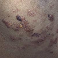 
	Lymphangioma circumscriptum