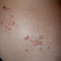 
	Lymphangioma circumscriptum