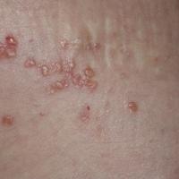 
	Lymphangioma circumscriptum: close-up
