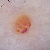 Dermoscopic appearance of previous figure - the…