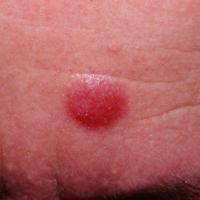 
	Lymphocytoma cutis