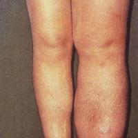 
	Lymphoedema