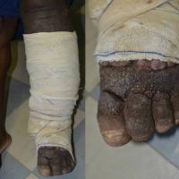 
	Elephantiasis secondary to filariasis