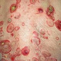 
	MF - annular lesions

	&nbsp;