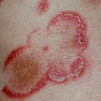 
	MF - arciform lesions&nbsp;

	Copied with kind…