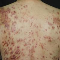 
	Leukaemia cutis

	Copied with kind permission…