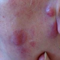 
	Marginal zone lymphoma