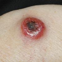
	Marginal zone lymphoma
