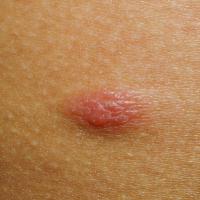 
	Marginal zone lymphoma

	Copied with kind…
