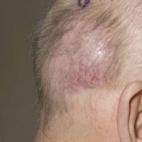 
	Lymphoma: unclassified&nbsp;