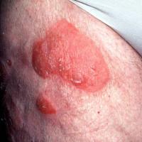 
	MF - plaque stage