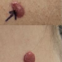 
	Diffuse large B-cell lymphoma

	Copied with…