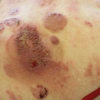 MF - plaques and ulcers