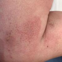 Same patient as previous image
Copied with kind…