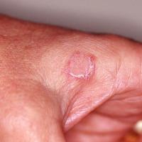 
	Pagetoid reticulosis