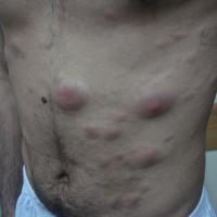 
	Follicle centre cell lymphoma