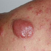 
	Follicle centre cell lymphoma